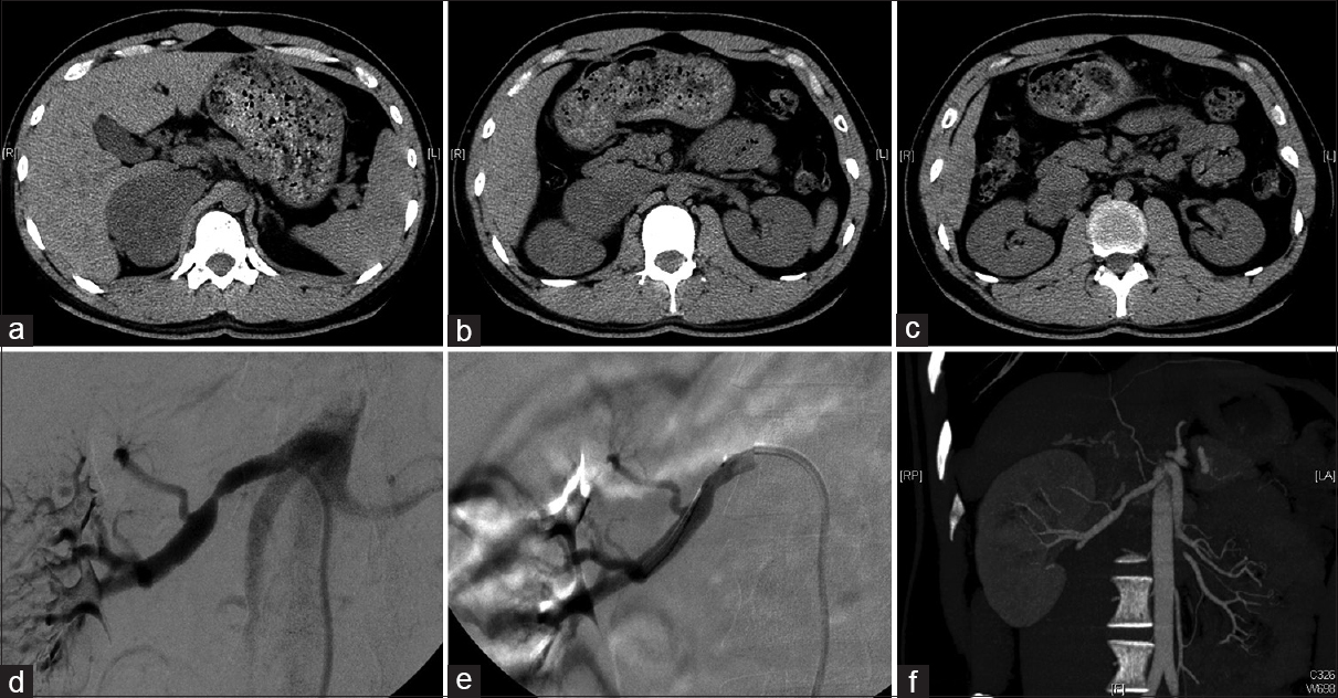 Figure 1: (a) Computed tomography examination showed a tumor in the adrenal area.</b> (b and c) Computed tomography revealed that the renal vessels were involved. (d) The renal artery angiography showed target narrowing lesion. (e) The angioplasty was performed. (f) The computed tomography angiography showed desirable recanalization at 2 months followup